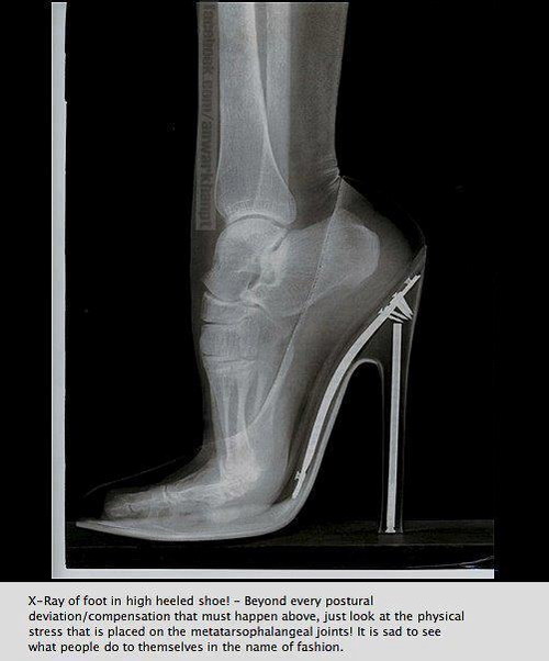 High heels cause arthritis in toes - Health - The Jakarta Post